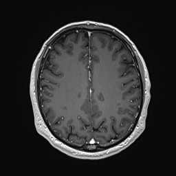 Cerebral arteriovenous malformation (Radiopaedia 84015-99245 Axial T1 C+ 107).jpg