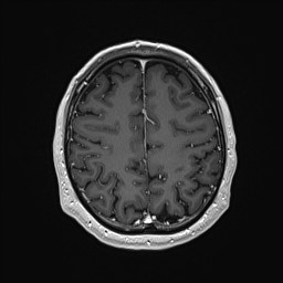Cerebral arteriovenous malformation (Radiopaedia 84015-99245 Axial T1 C+ 118).jpg