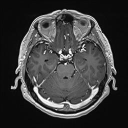 File:Cerebral arteriovenous malformation (Radiopaedia 84015-99245 Axial T1 C+ 59).jpg