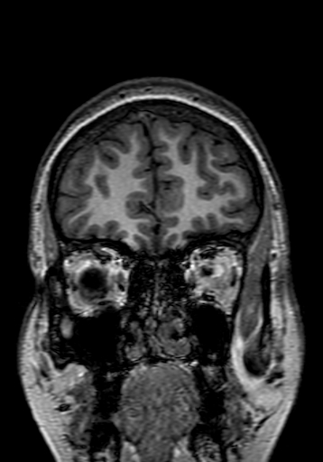 Cerebral arteriovenous malformation at posterior body of corpus callosum (Radiopaedia 74111-84925 Coronal T1 33).jpg