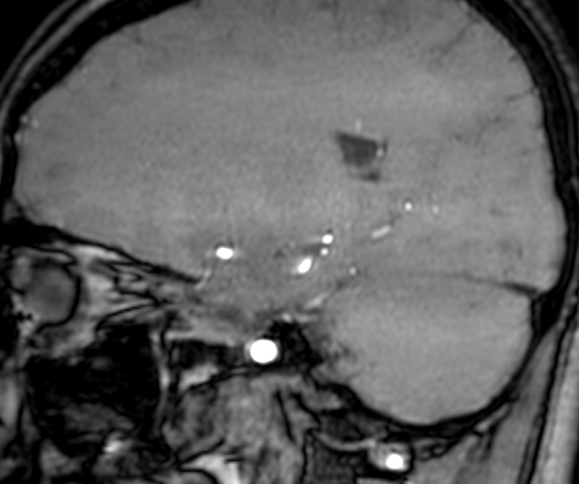 Cerebral arteriovenous malformation at posterior body of corpus callosum (Radiopaedia 74111-84925 J 134).jpg