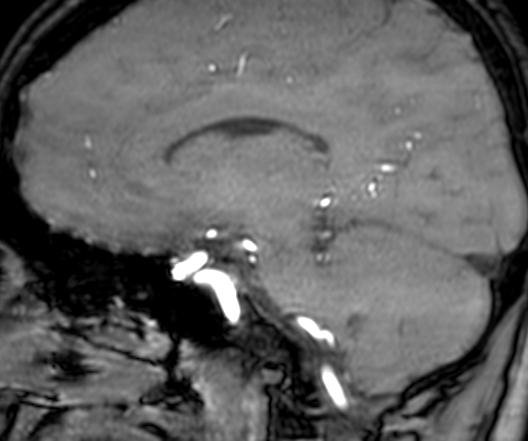 Cerebral arteriovenous malformation at posterior body of corpus callosum (Radiopaedia 74111-84925 J 226).jpg