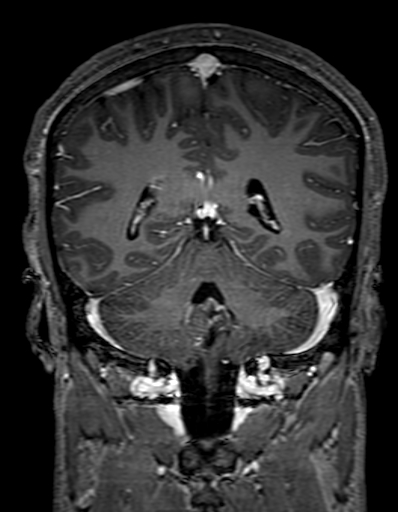 Cerebral arteriovenous malformation at posterior body of corpus callosum (Radiopaedia 74111-84925 K 252).jpg