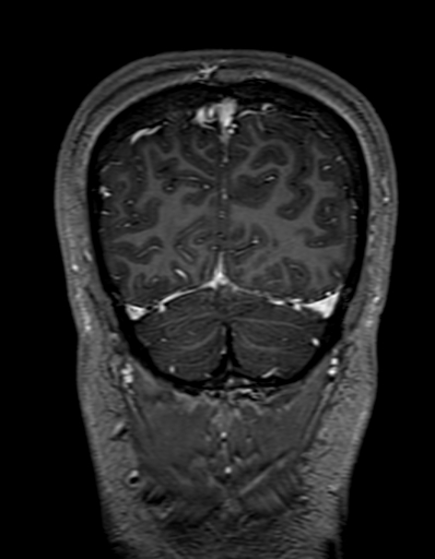 Cerebral arteriovenous malformation at posterior body of corpus callosum (Radiopaedia 74111-84925 K 324).jpg