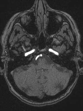 Cerebral arteriovenous malformation with hemorrhage (Radiopaedia 34422-35737 Axial MRA 16).png