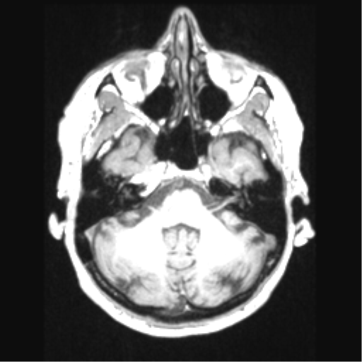 Cerebral arteriovenous malformation with hemorrhage (Radiopaedia 34422-35737 Axial T1 19).png