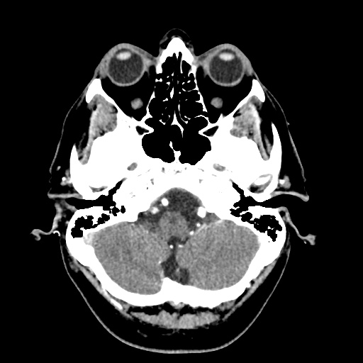 Cerebral arteriovenous malformation with lobar hemorrhage (Radiopaedia 35598-57216 A 11).jpg