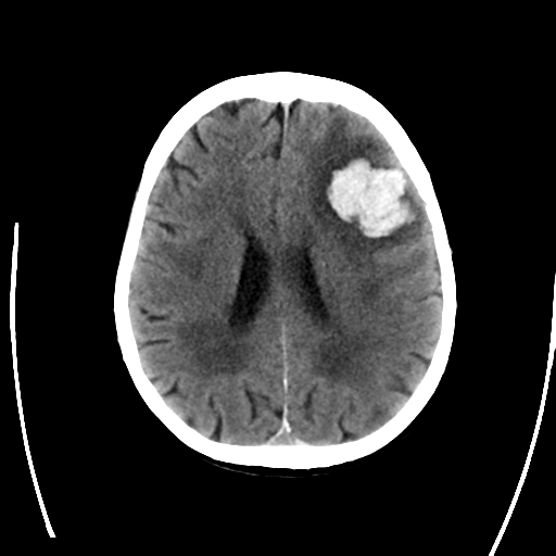 File:Cerebral arteriovenous malformation with lobar hemorrhage (Radiopaedia 44725-48512 Axial non-contrast 23).png