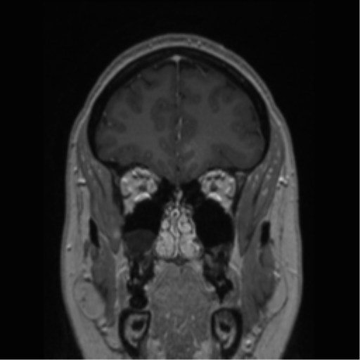 Cerebral cavernoma and development venous anomaly (Radiopaedia 37603-39482 Coronal T1 C+ 73).png