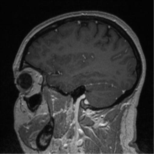 File:Cerebral cavernoma and development venous anomaly (Radiopaedia 37603-39482 Sagittal T1 C+ 29).png