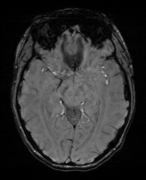 Cerebral cavernous venous malformation (Radiopaedia 70008-80021 I 32).jpg