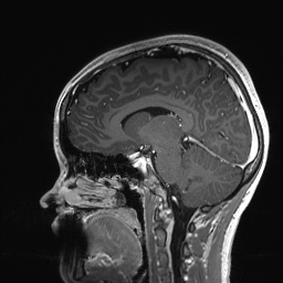 Cerebral cavernous venous malformation (Radiopaedia 70008-80021 Sagittal T1 C+ 40).jpg