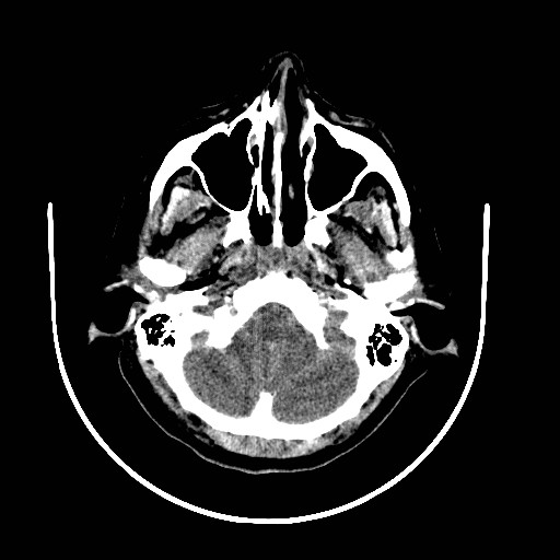 File:Cerebral edema (evolution in time) (Radiopaedia 19418-19439 non-contrast 13).jpg