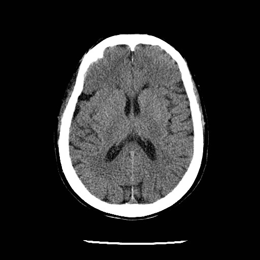 File:Cerebral edema (evolution in time) (Radiopaedia 19418-19441 non-contrast 58).jpg