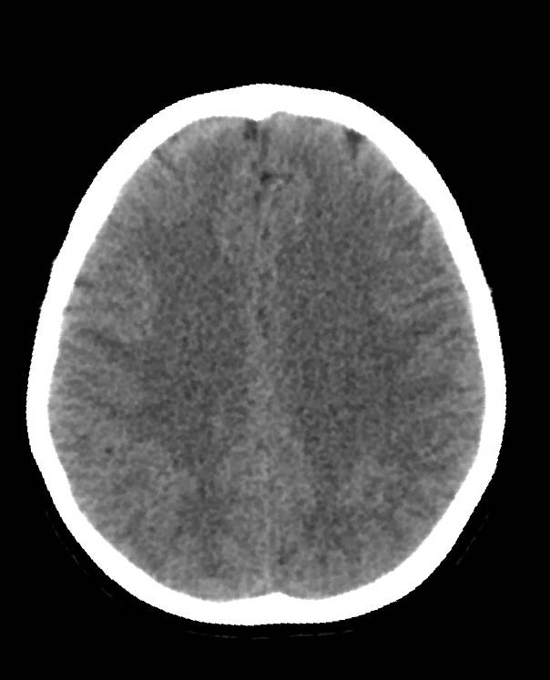 Cerebral edema due to severe hyponatremia (Radiopaedia 89826-106938 Axial non-contrast 69).jpg