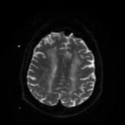 File:Cerebral embolic infarcts (embolic shower) (Radiopaedia 49837-55108 Axial DWI 14).jpg