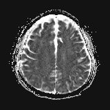 File:Cerebral embolic infarcts (embolic shower) (Radiopaedia 72391-82921 Axial ADC 21).jpg