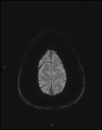 File:Cerebral fat embolism (Radiopaedia 35022-36525 Axial SWI 63).jpg