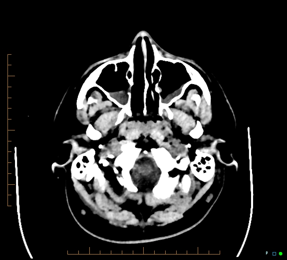 Cerebral fat embolism (Radiopaedia 85521-101220 Axial non-contrast 12).jpg