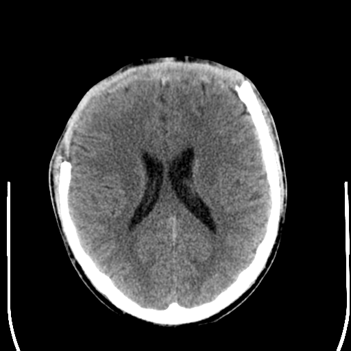 File:Cerebral hemorrhagic contusions- temporal evolution (Radiopaedia 40224-42756 Axial non-contrast 16).png