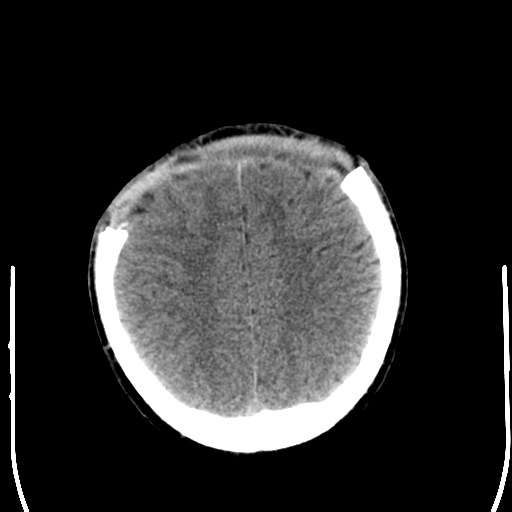 File:Cerebral hemorrhagic contusions- temporal evolution (Radiopaedia 40224-42756 Axial non-contrast 21).png
