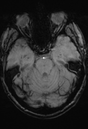 File:Cerebral hemorrhagic contusions- temporal evolution (Radiopaedia 40224-42757 D 12).png