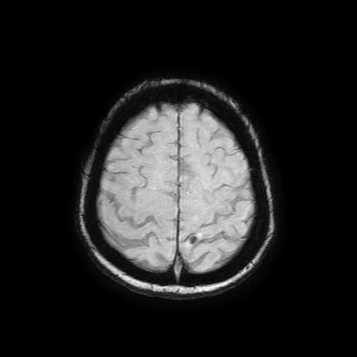 File:Cerebral metastases - melanoma (Radiopaedia 80972-94522 Axial SWI 81).jpg