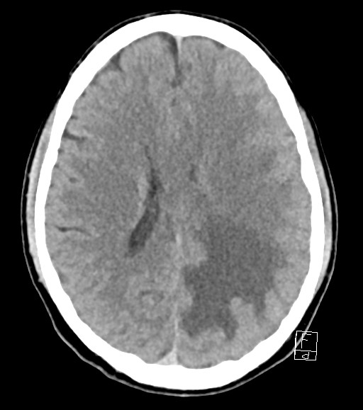Cerebral metastases - testicular choriocarcinoma (Radiopaedia 84486-99855 Axial non-contrast 24).jpg