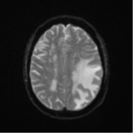 Cerebral metastasis (Radiopaedia 46744-51248 Axial DWI 19).png