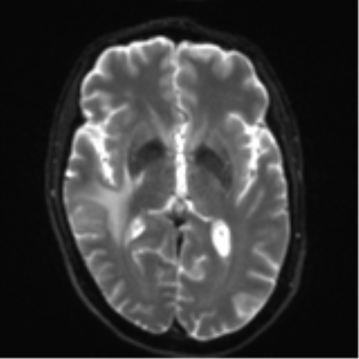 Cerebral metastasis - melanoma (Radiopaedia 54718-60954 Axial DWI 15).png