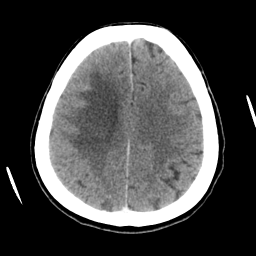 Cerebral metastasis to basal ganglia (Radiopaedia 81568-95412 Axial C+ delayed 42).png