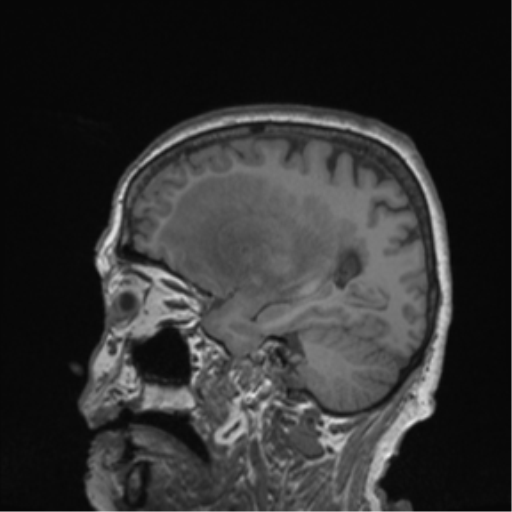 Cerebral metastasis to basal ganglia (Radiopaedia 81568-95413 Sagittal T1 51).png