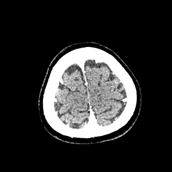 Cerebral ring enhancing lesions - cerebral metastases (Radiopaedia 44922-48818 B 256).jpg