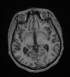 Cerebral toxoplasmosis (Radiopaedia 43956-47461 Axial T1 35).jpg