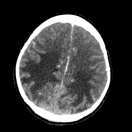 Cerebral tuberculosis with dural sinus invasion (Radiopaedia 60353-68019 Axial C+ delayed 46).jpg