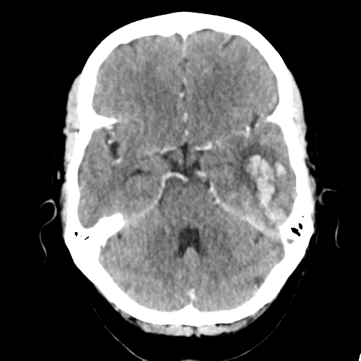 Cerebral venous hemorrhagic infarction (Radiopaedia 57576-64538 Axial C+ 15).png