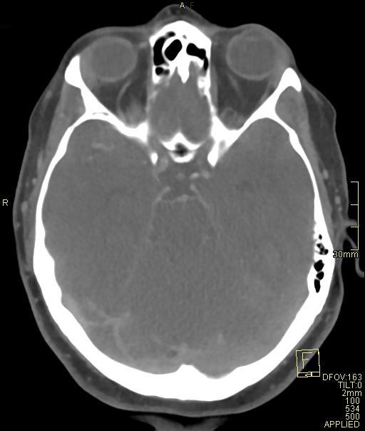 Cerebral venous sinus thrombosis (Radiopaedia 91329-108965 Axial venogram 31).jpg