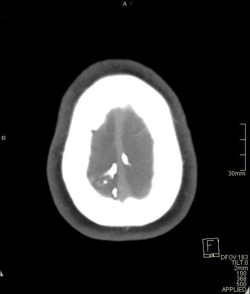 Cerebral venous sinus thrombosis (Radiopaedia 91329-108965 Axial venogram 73).jpg