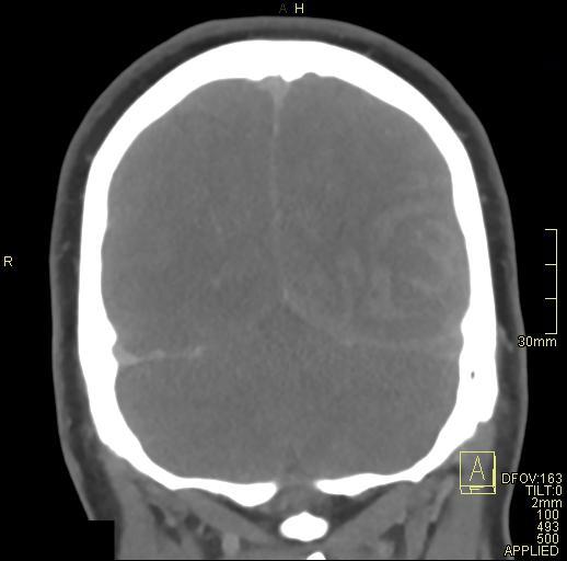 Cerebral venous sinus thrombosis (Radiopaedia 91329-108965 Coronal venogram 71).jpg