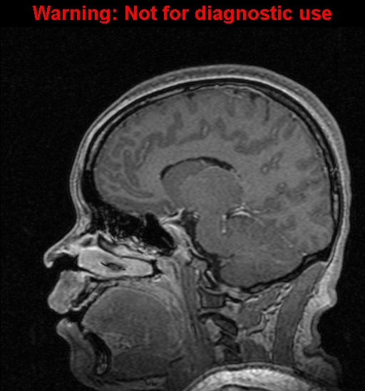 File:Cerebral venous thrombosis (Radiopaedia 37224-39208 Sagittal T1 C+ 66).jpg