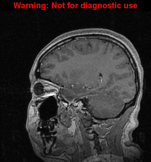 Cerebral venous thrombosis (Radiopaedia 37224-39208 Sagittal T1 C+ 99).jpg