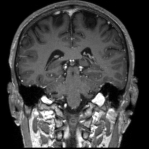 Cerebral venous thrombosis (Radiopaedia 38392-40469 Coronal T1 C+ 35).png