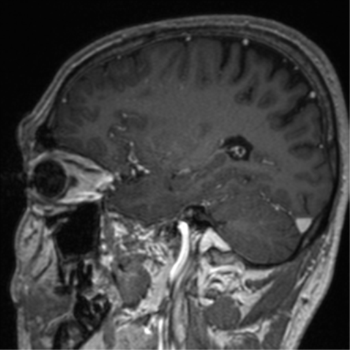 Cerebral venous thrombosis (Radiopaedia 38392-40469 Sagittal T1 C+ 31).png