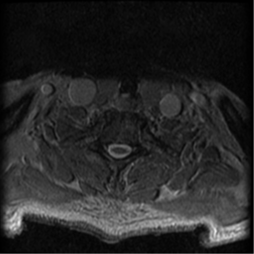 Cervical canal stenosis with cord compression (Radiopaedia 34114-35374 Axial Gradient Echo 16).png