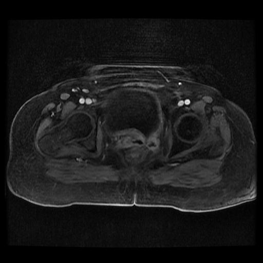 Cervical carcinoma (Radiopaedia 70924-81132 Axial T1 C+ fat sat 127).jpg