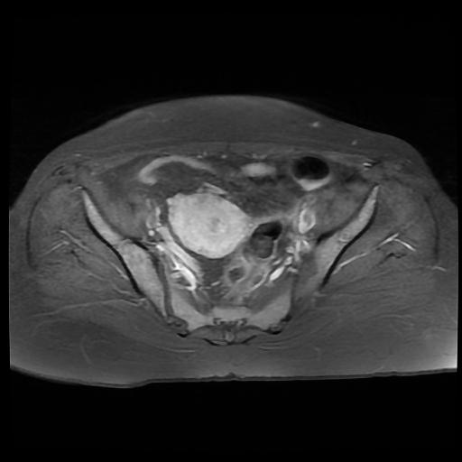 File:Cervical carcinoma (Radiopaedia 88010-104555 Axial T1 C+ fat sat 8).jpg