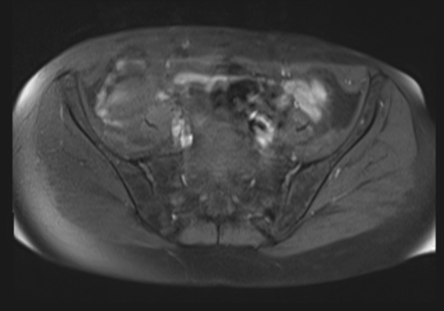 File:Cervical carcinoma (Radiopaedia 88312-104943 Axial T1 fat sat 6).jpg