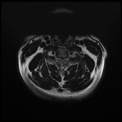File:Cervical disc extrusion (Radiopaedia 59074-66364 Axial T2 5).jpg
