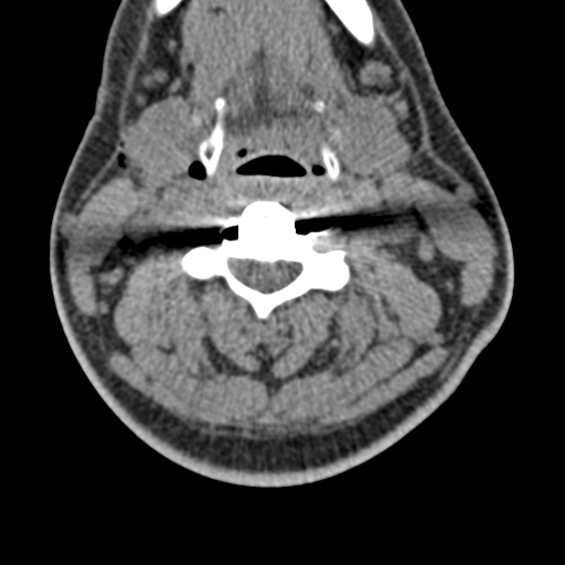 Cervical disc replacement (Radiopaedia 44025-47541 B 1).png