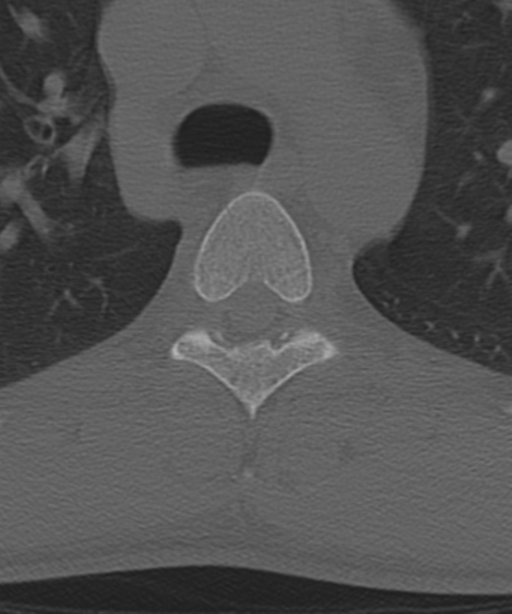 Cervical intercalary bone (Radiopaedia 35211-36748 Axial bone window 82).png